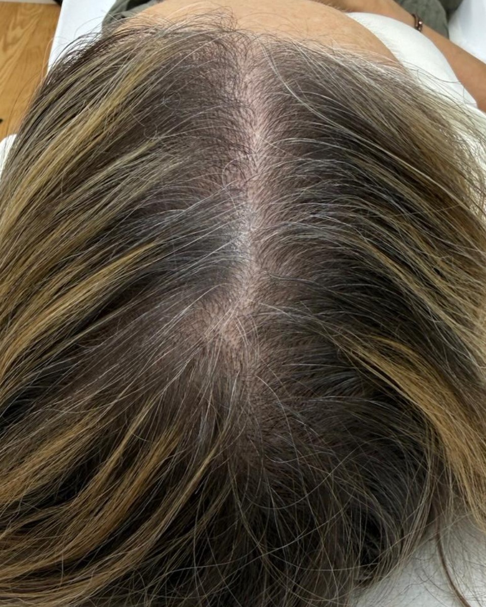 Mejora de densidad capilar tras mesoterapia médica
