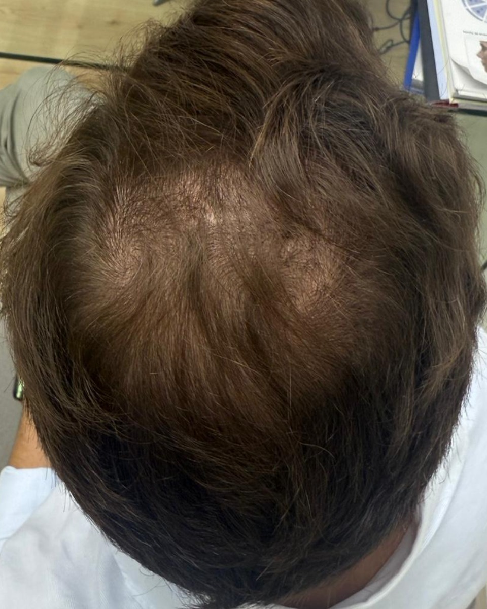 Coronilla con adelgazamiento visible antes de mesoterapia capilar
