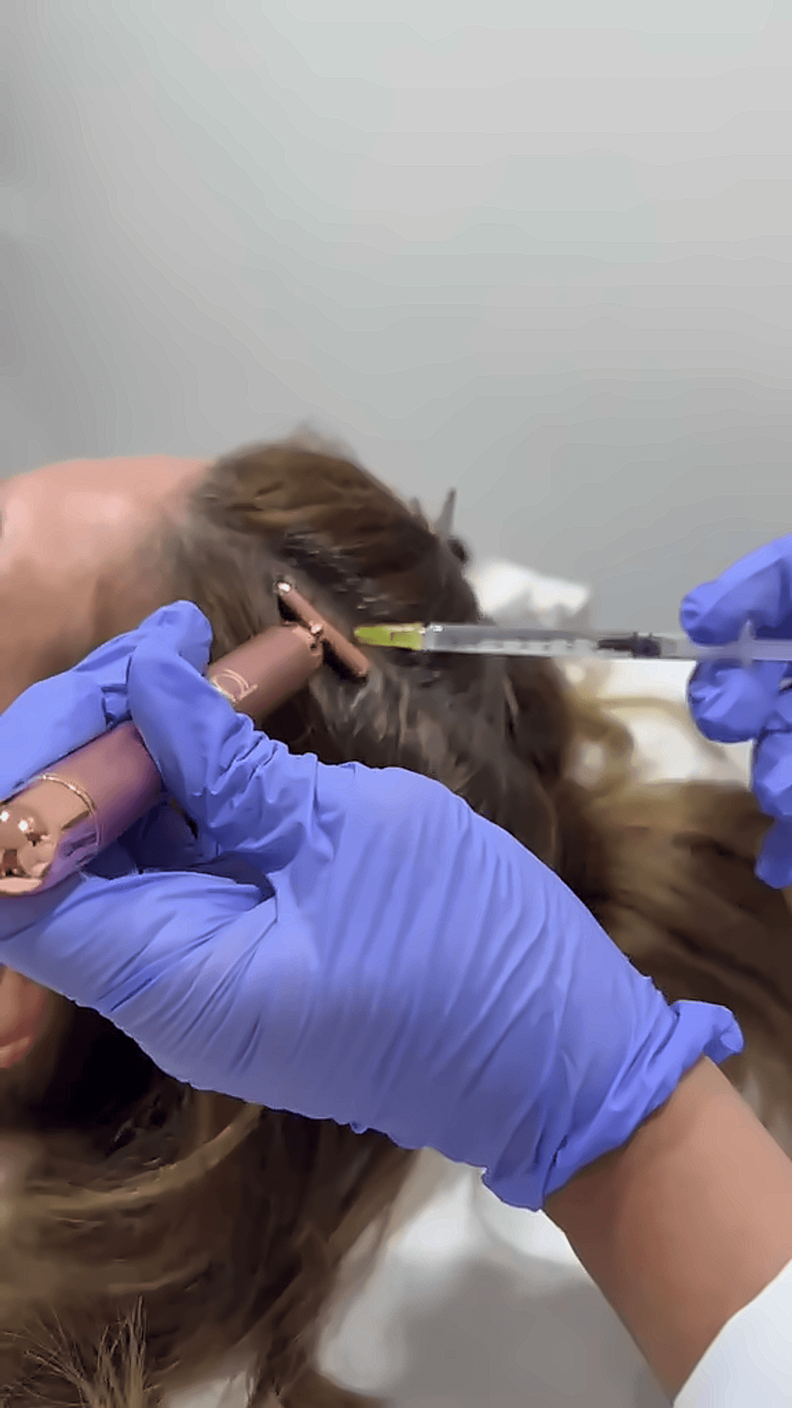 Aplicación de mesoterapia capilar en cuero cabelludo