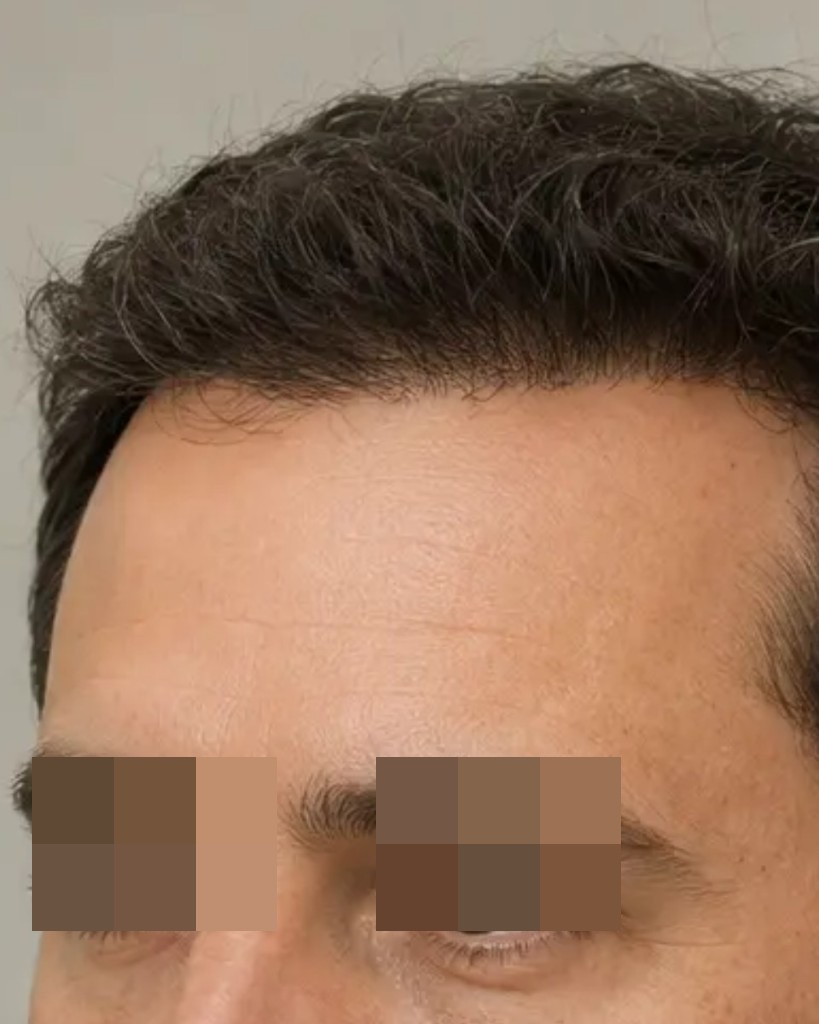 Mejora de línea frontal tras transplante capilar médico