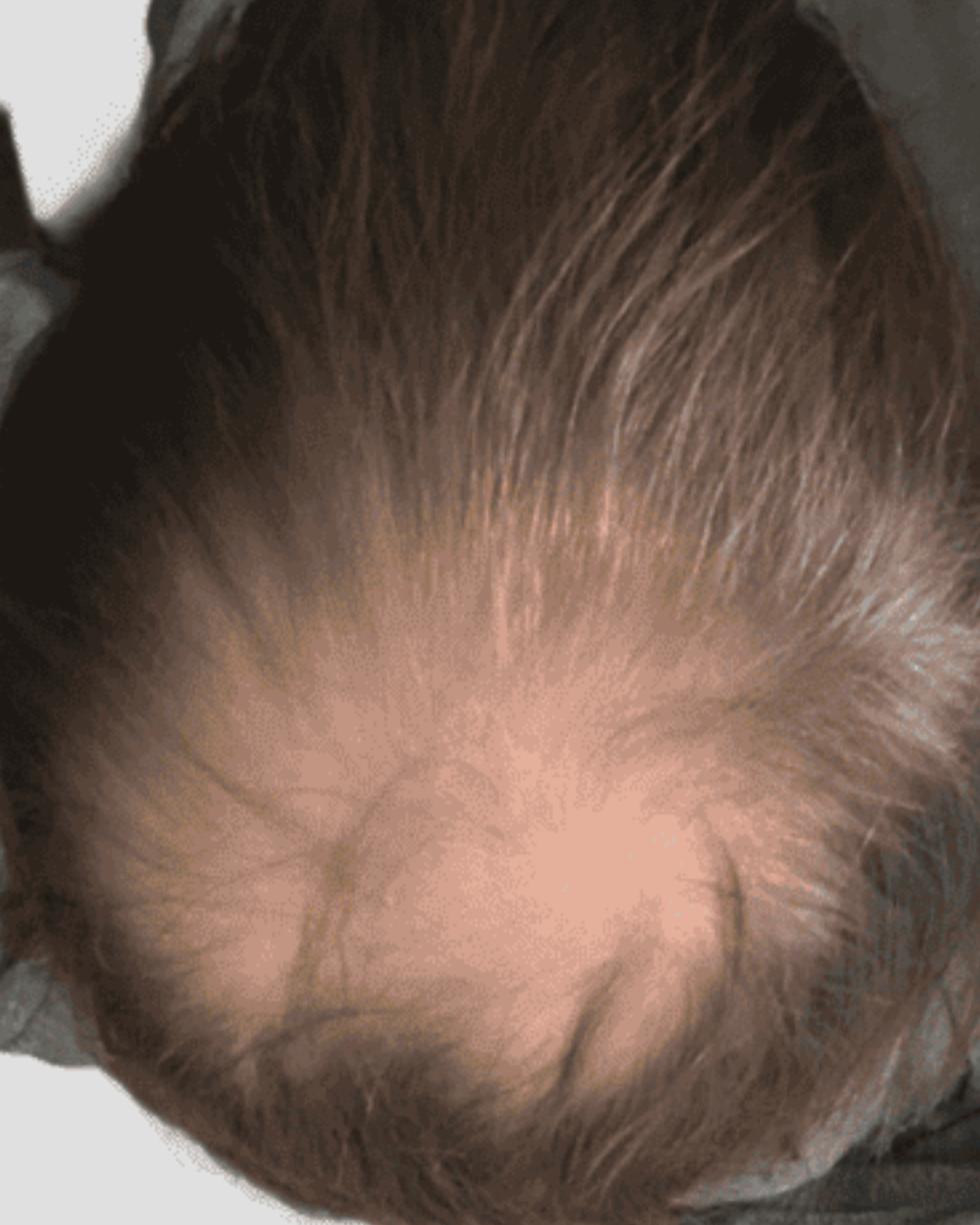 Coronilla con adelgazamiento visible antes de transplante capilar
